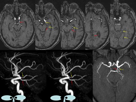 anterior choroidal artery radiology